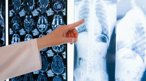 Eine Ärztin deutet mit dem Finger auf das Bild eines Lungenröntgens.